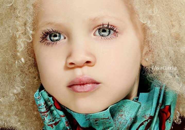 Ава Кларк - афроамериканка албинос